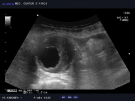 Ultrazvok žil trebuha - anevrizma z muralnim (stenski) trombom abdominalne aorte